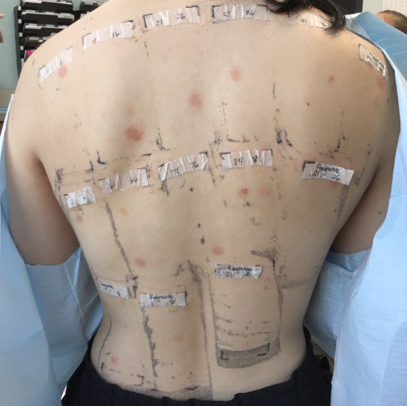 Patch tests stuck on the back of a woman, Tests for skin allergens