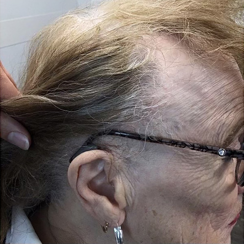 Alopecia After Dermatology Specialists of Spokane